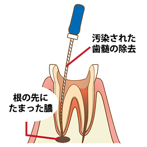 【2】根管を洗浄・消毒する
